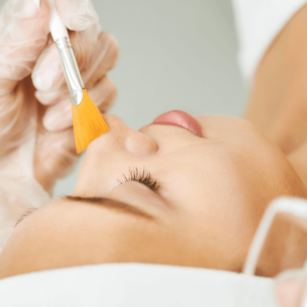 chemical peel
